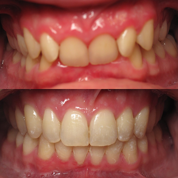 orthodontics_5-4 before and after