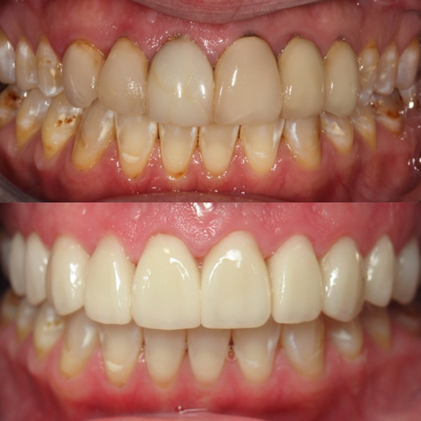smile makeover_2-2 before and after